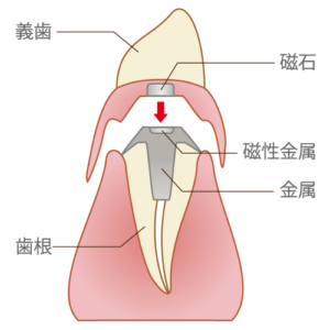 false-tooth012